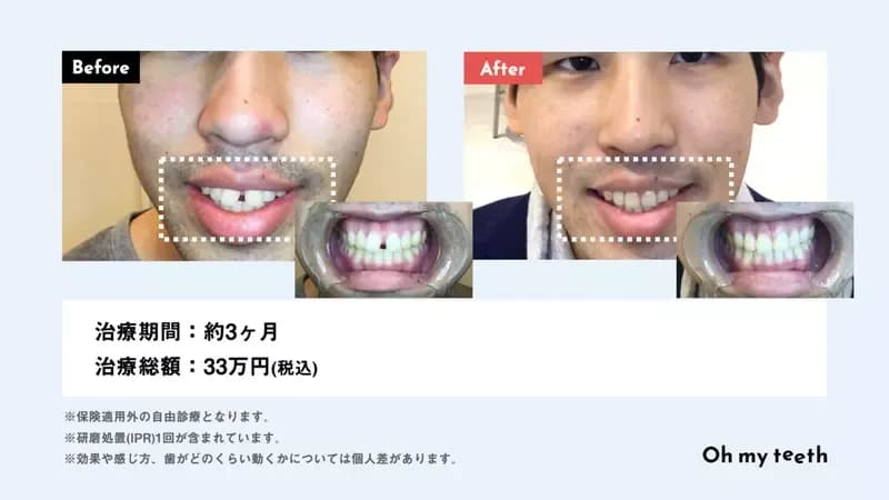 マウスピース矯正 Oh my teethのすきっ歯(空隙歯列)の症例
