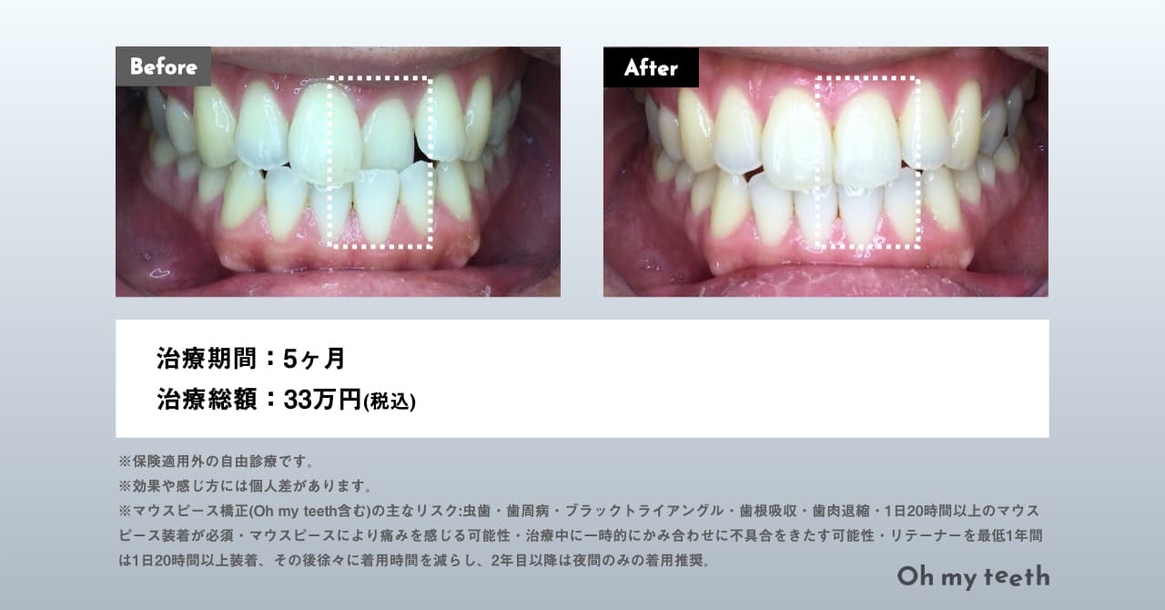 マウスピース矯正Oh my teethの症例写真(反対咬合・部分矯正)