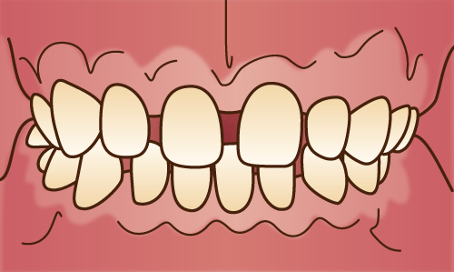 歯が小さいのを大きくできる？原因や治し方を解説