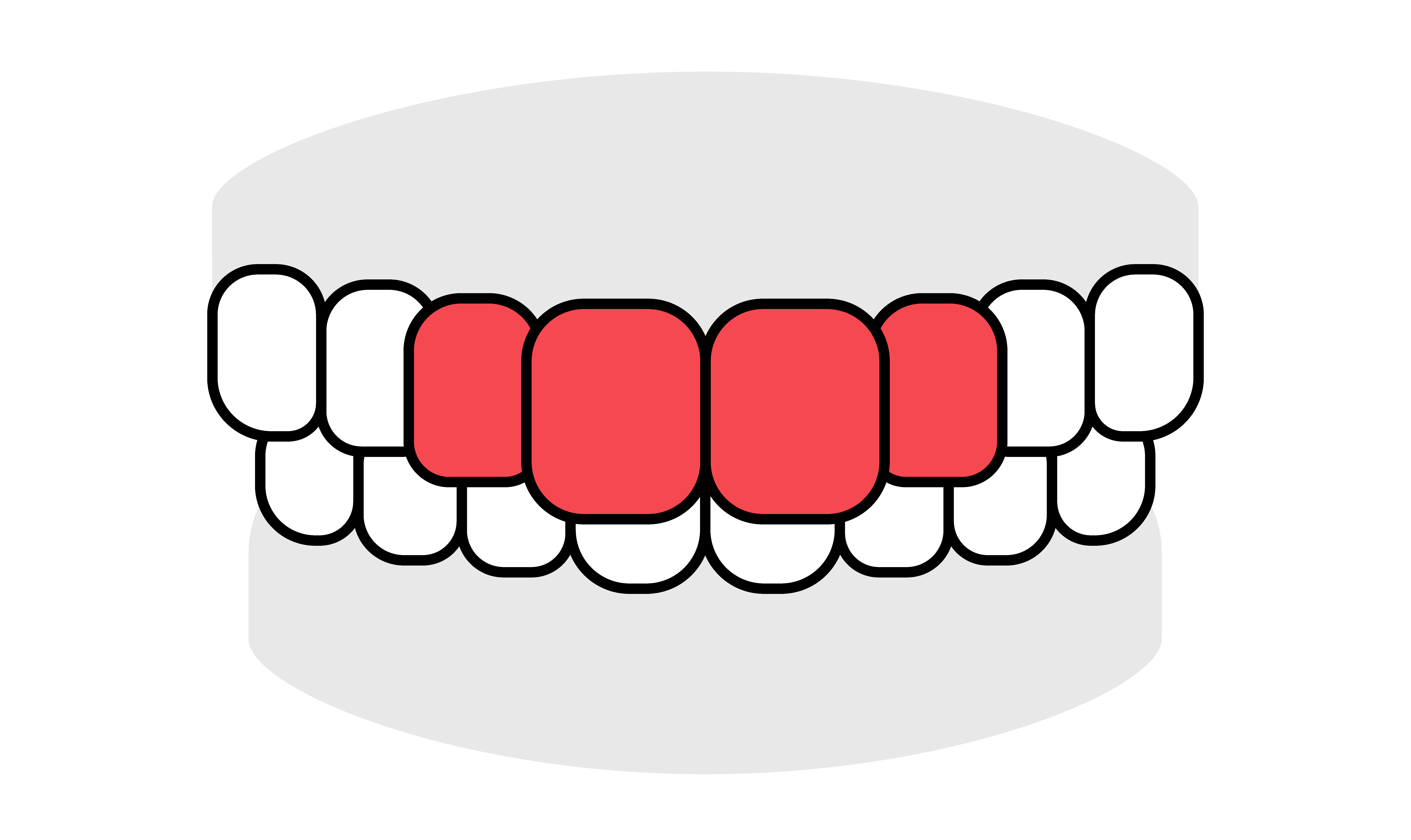 OMT歯並びイラスト出っ歯正面