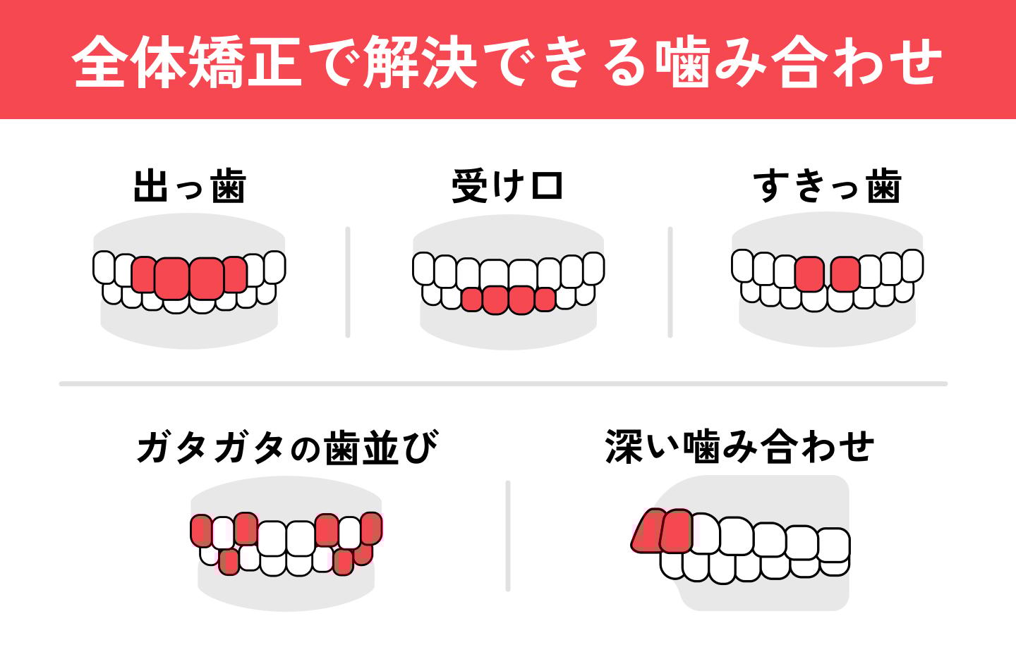 インビザラインで治せる噛み合わせ