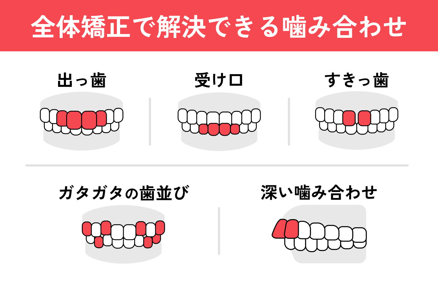 インビザラインで治せる噛み合わせ