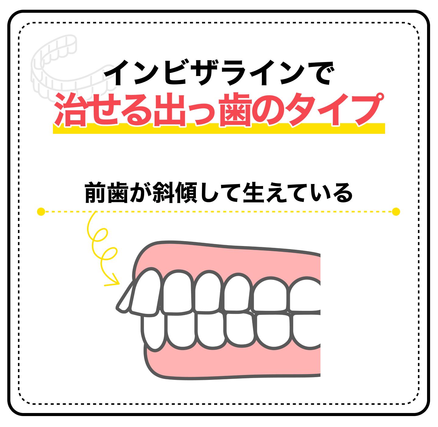説明画像2（出っ歯はインビザライン矯正で治せる？）