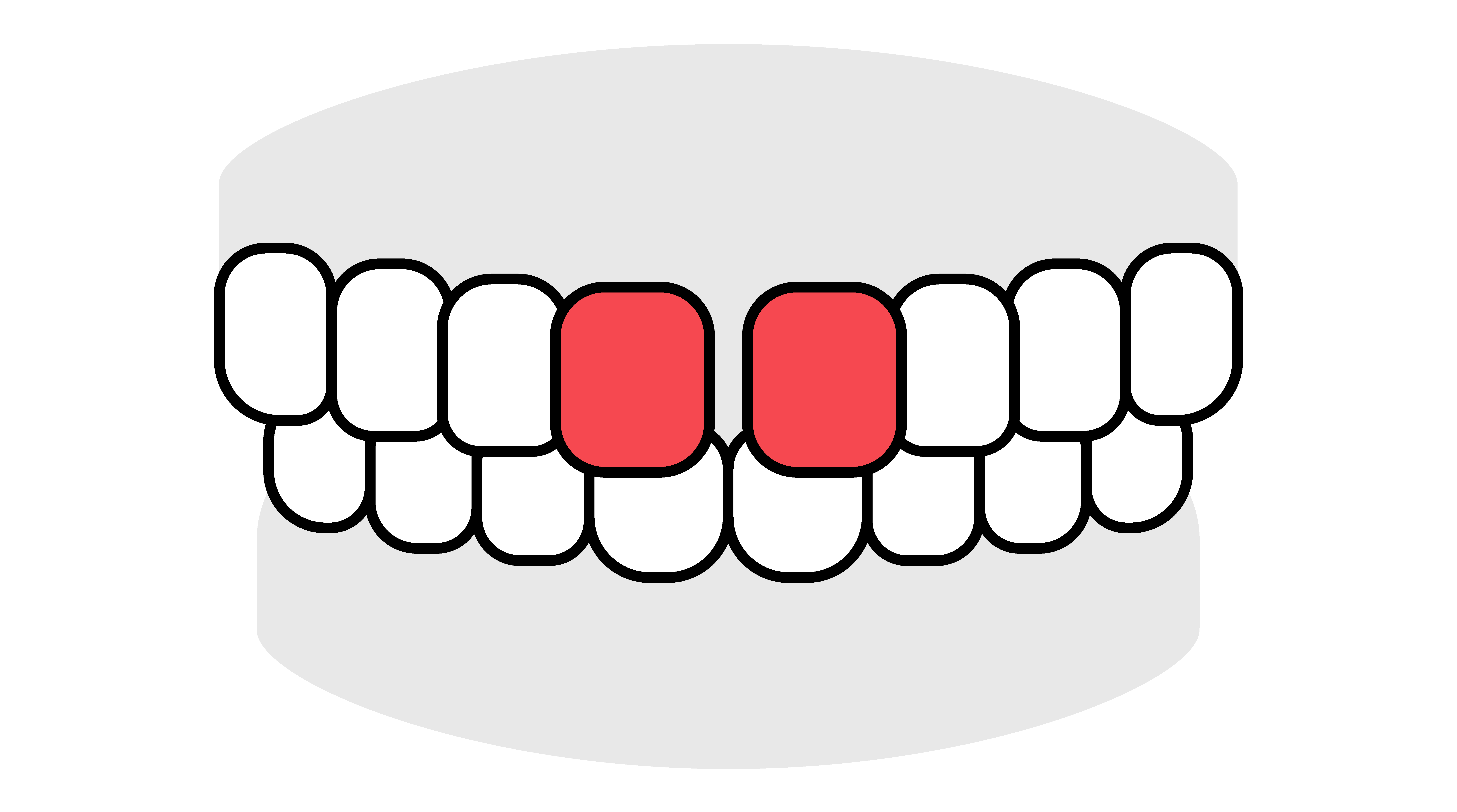 OMT歯並びイラストすきっ歯