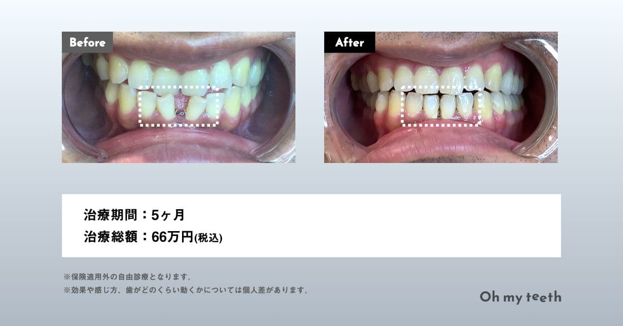 マウスピース矯正 Oh my teethのすきっ歯(空隙歯列)の症例(全体矯正)