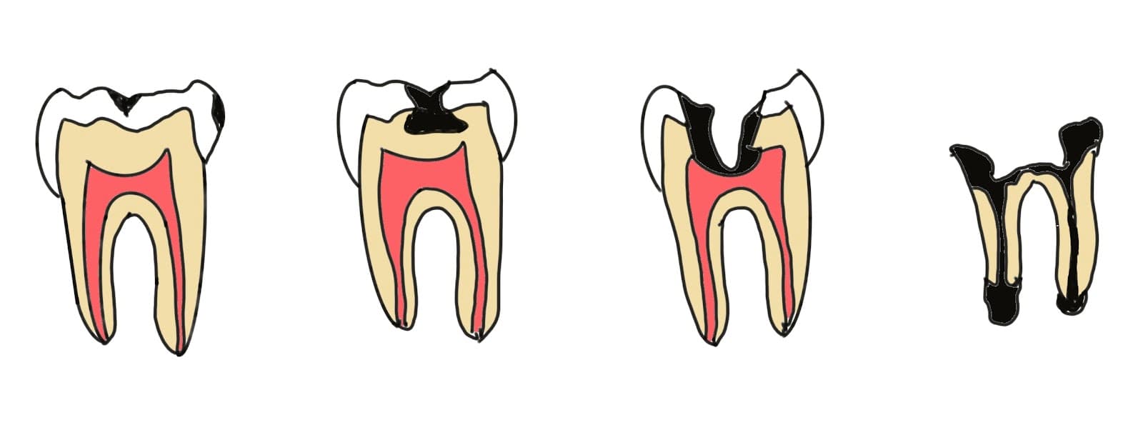 虫歯の進行度を表したイラスト