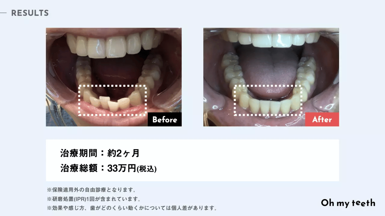 歯並びが悪くなる原因と種類・治療方法を解説  