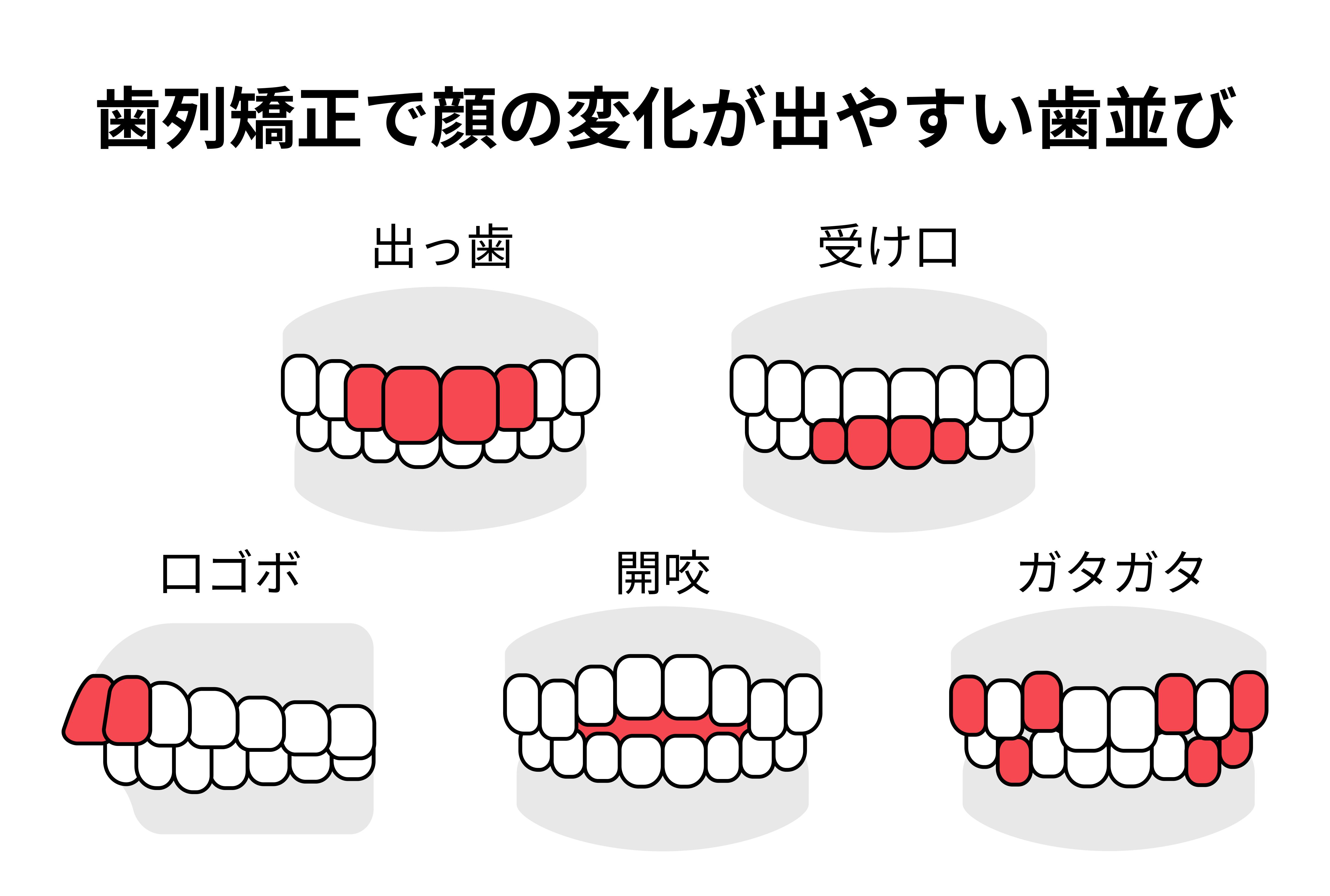 歯列矯正で顔の変化が出やすい歯並びとは?