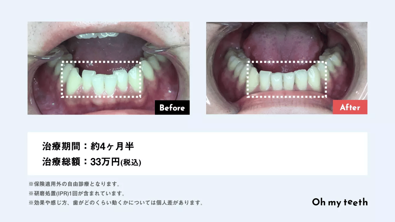 通わないマウスピース矯正 Oh my teethのメリット・デメリットを公式ブログ担当が徹底解説