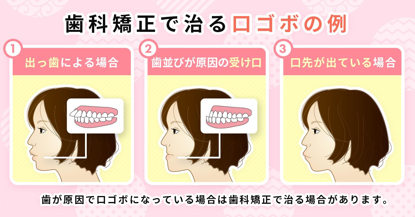 歯科矯正で治る口ゴボの例