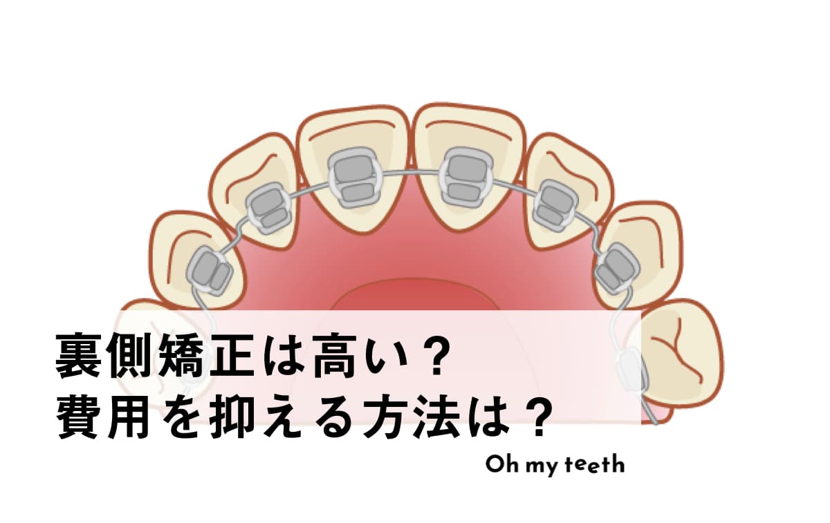 裏側矯正の値段はいくら？