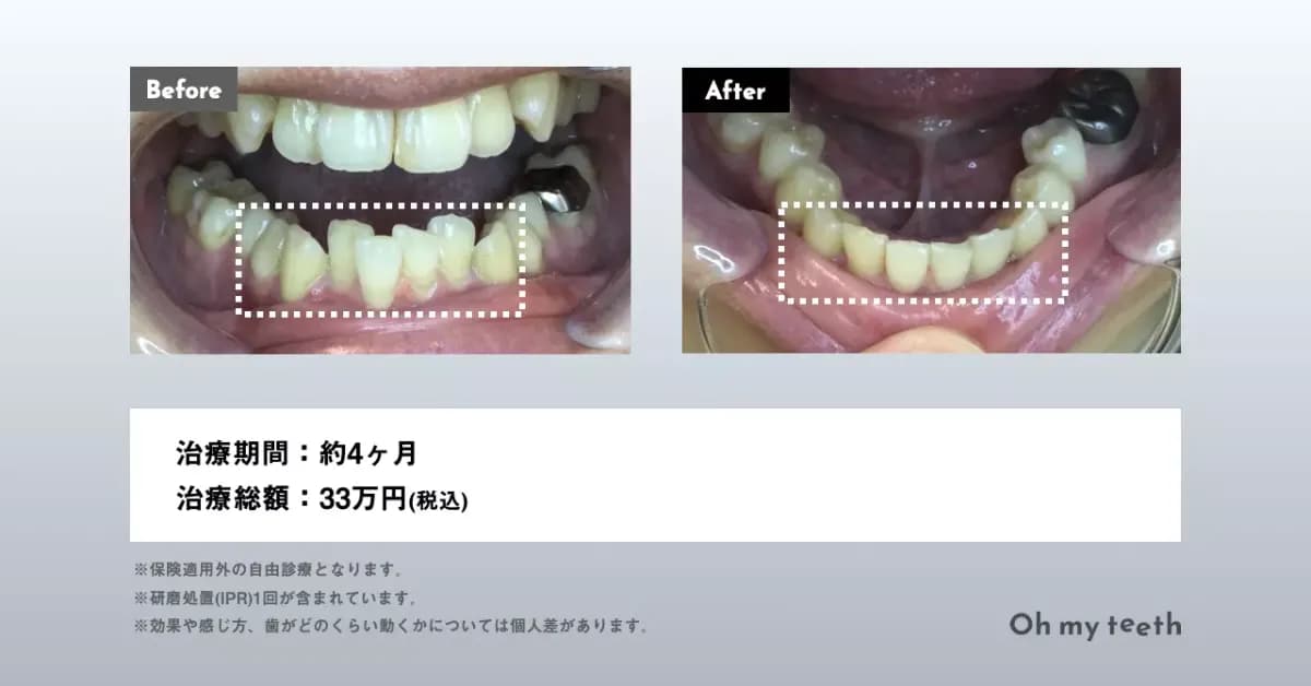 マウスピース矯正 Oh my teethのデコボコの歯並び(叢生)の症例(部分矯正・非抜歯矯正)