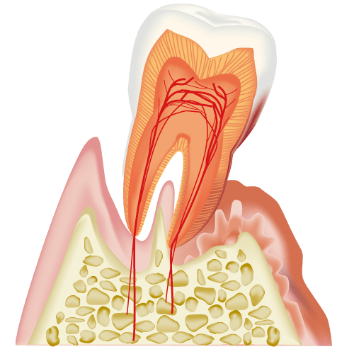 歯周病
