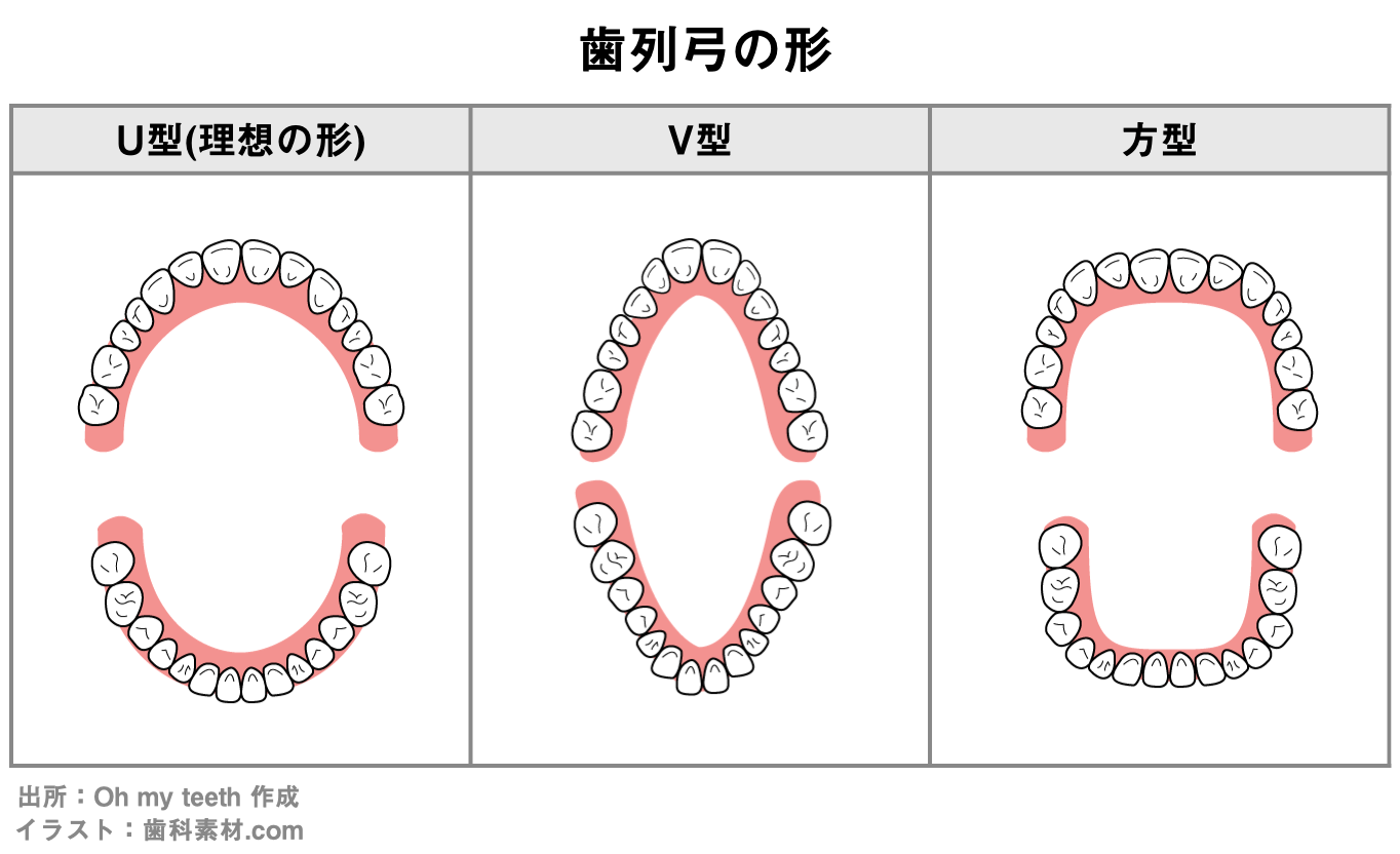 歯並びが良い・悪いを決める4つの条件