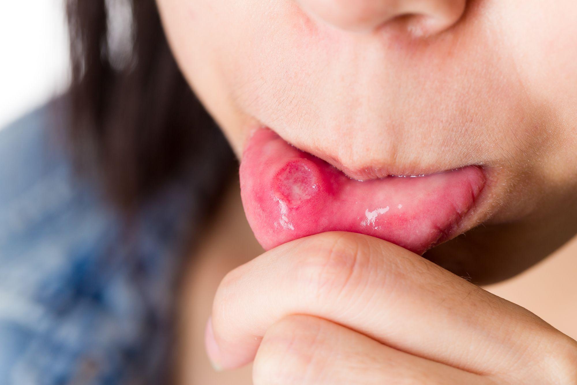 矯正中の口内炎が痛すぎるときの対処法5つ！原因や予防法も紹介