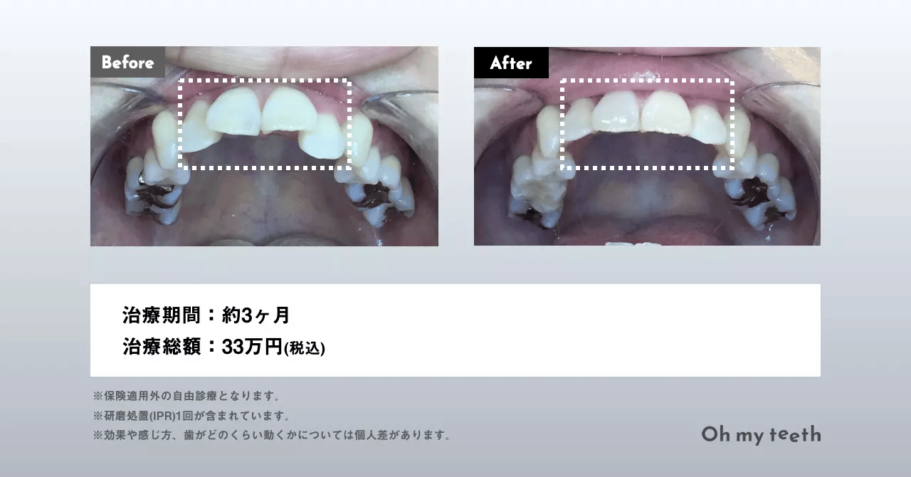 歯並びが悪くなる原因と種類・治療方法を解説  