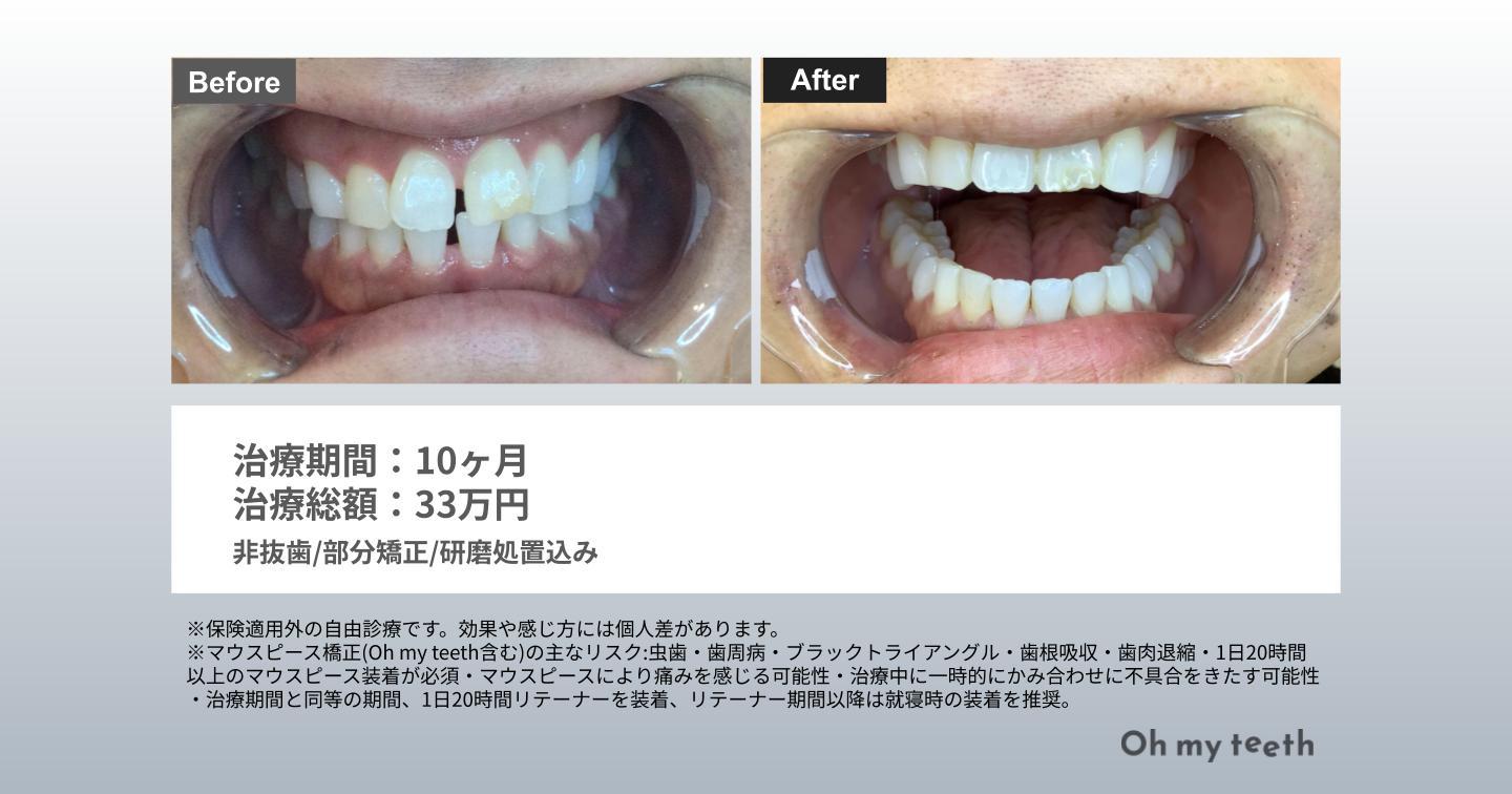 46歳・男性・Basic・10カ月症例（すきっ歯）