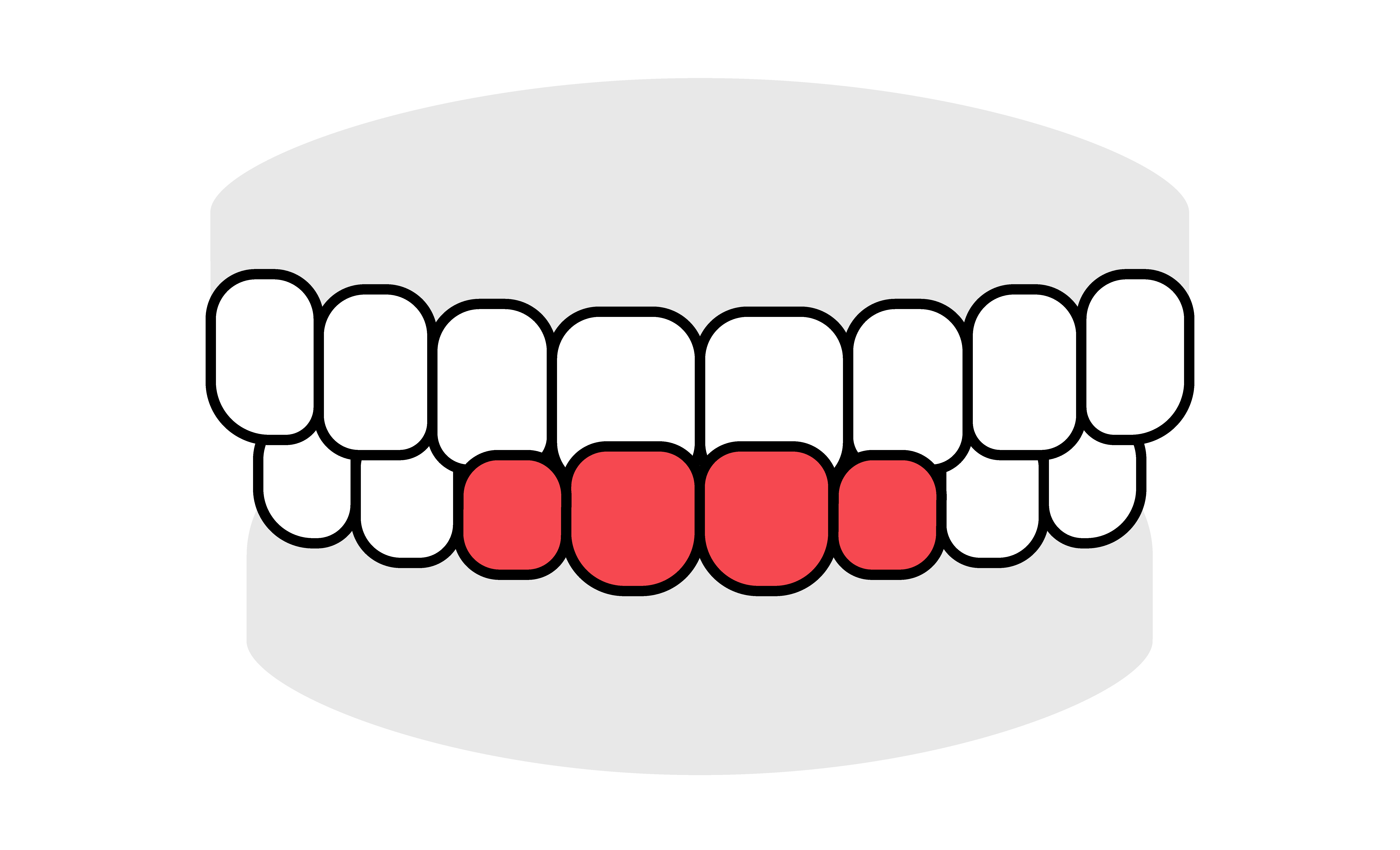 OMT歯並びイラスト受け口