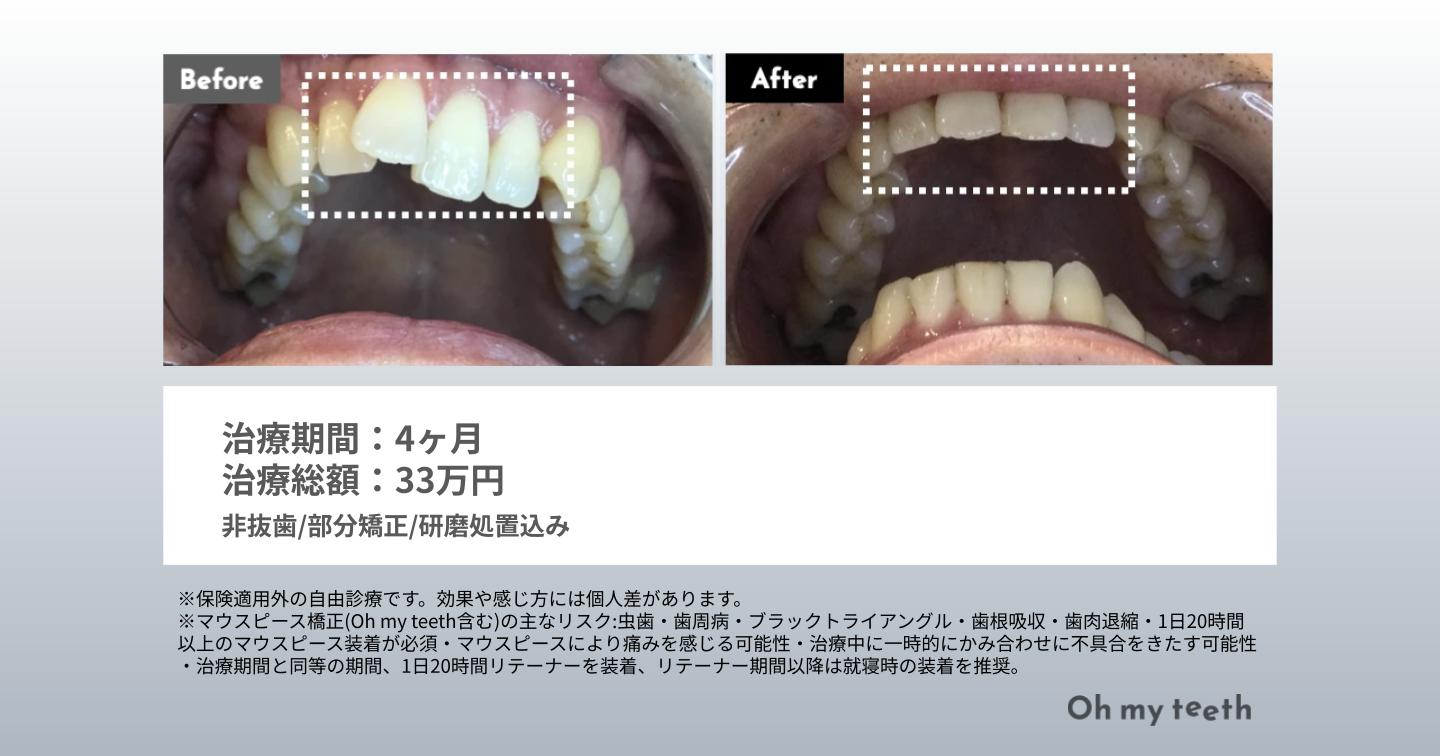 捻転歯 症例写真(ねじれ4ヶ月)