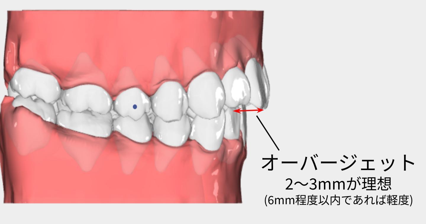 オーバージェットの目安(出っ歯の目安)