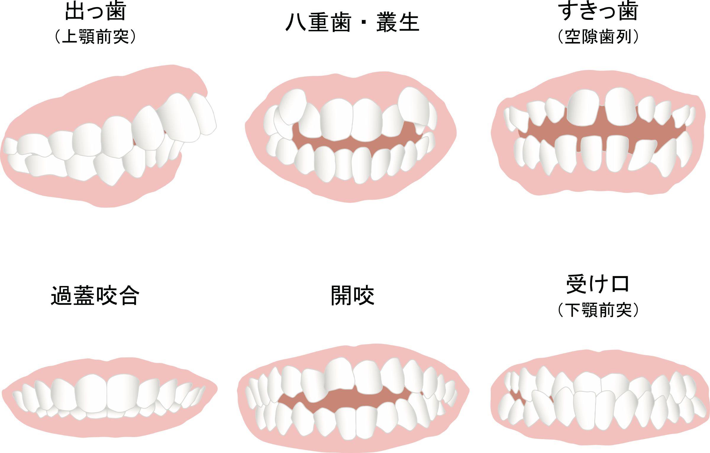 矯正中に滑舌が悪くなる原因とよくするコツ！歯並びによる影響も解説 