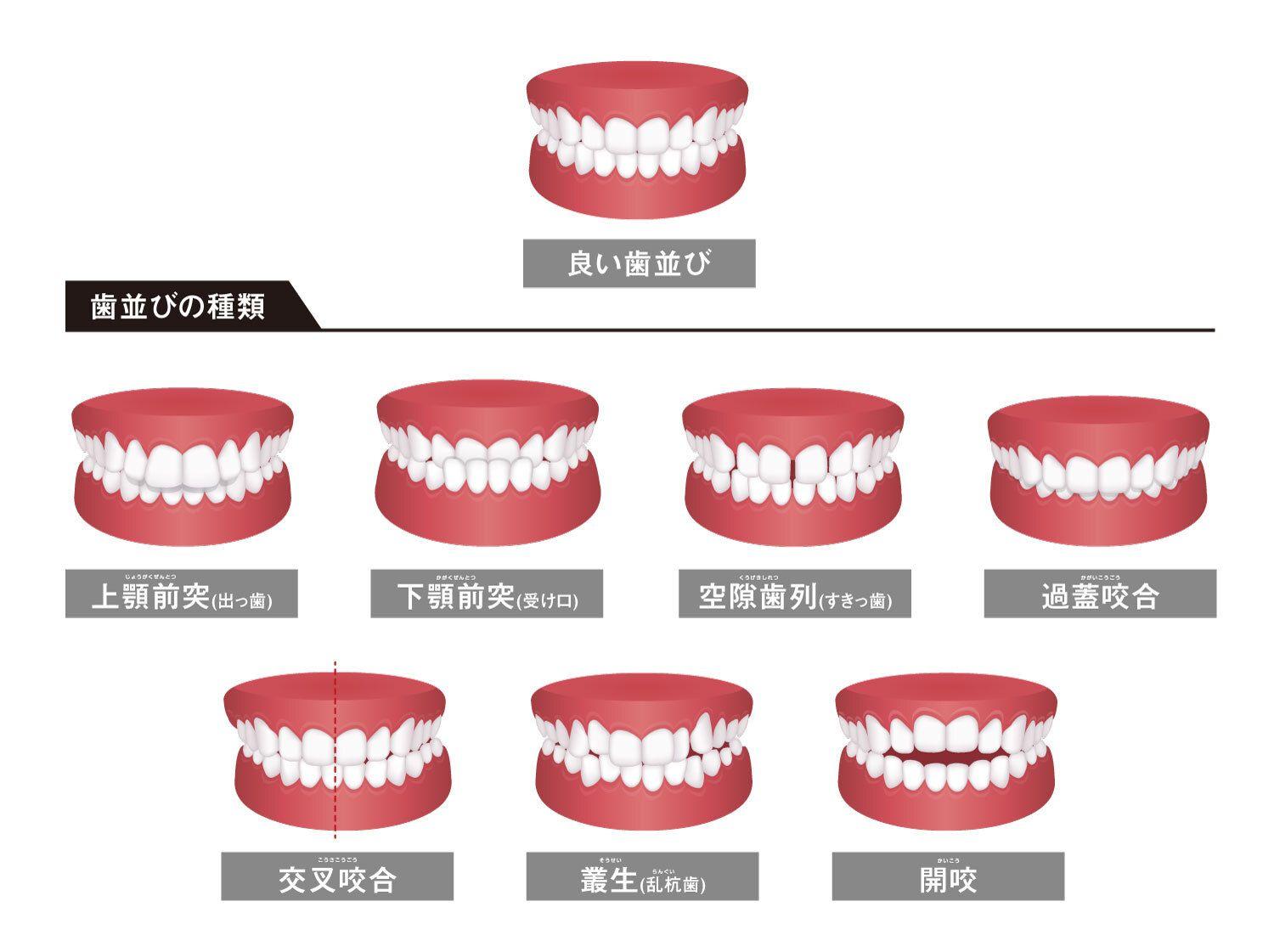 歯並びが良い・悪いを決める4つの条件