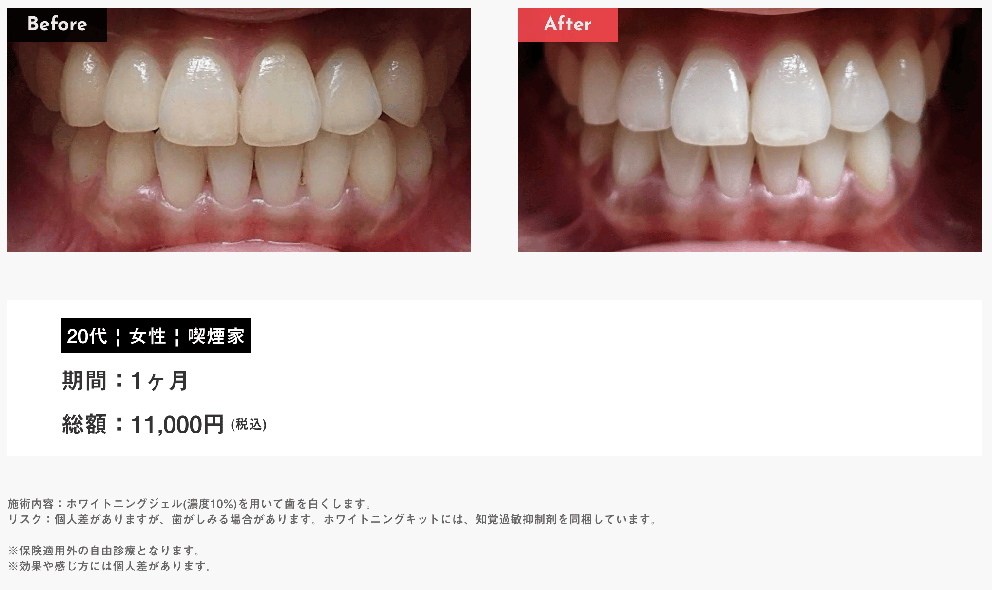 歯のホワイトニングホームケア！12回分