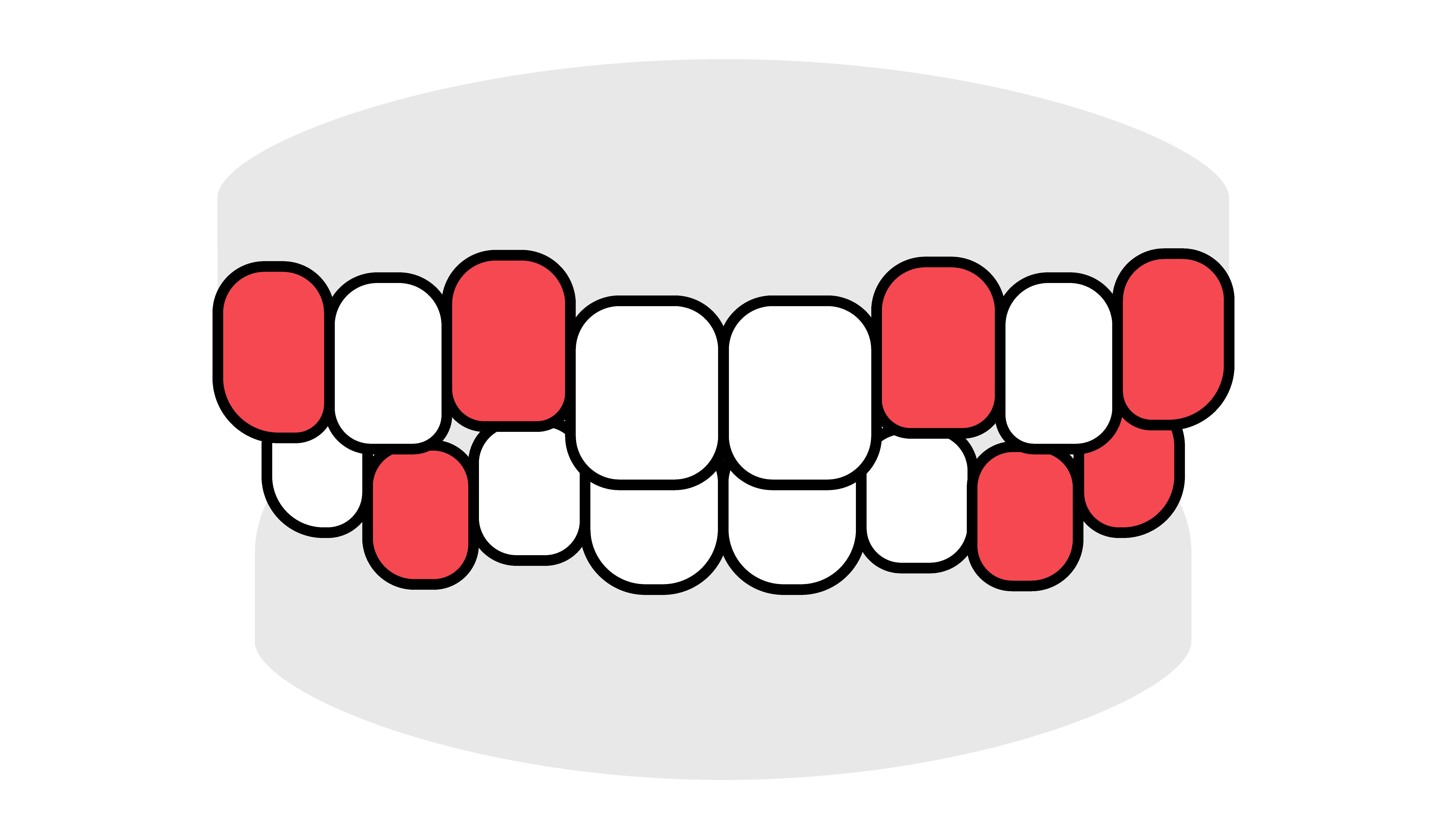 OMT歯並びイラスト叢生