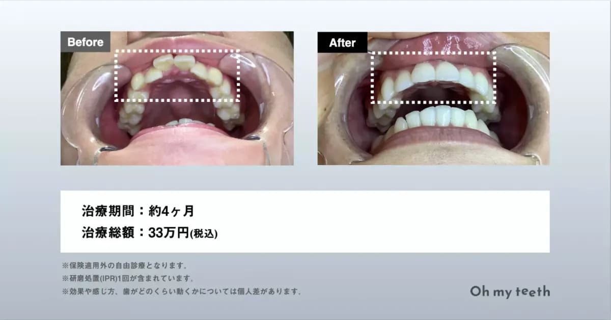 マウスピース矯正 Oh my teethの出っ歯の症例