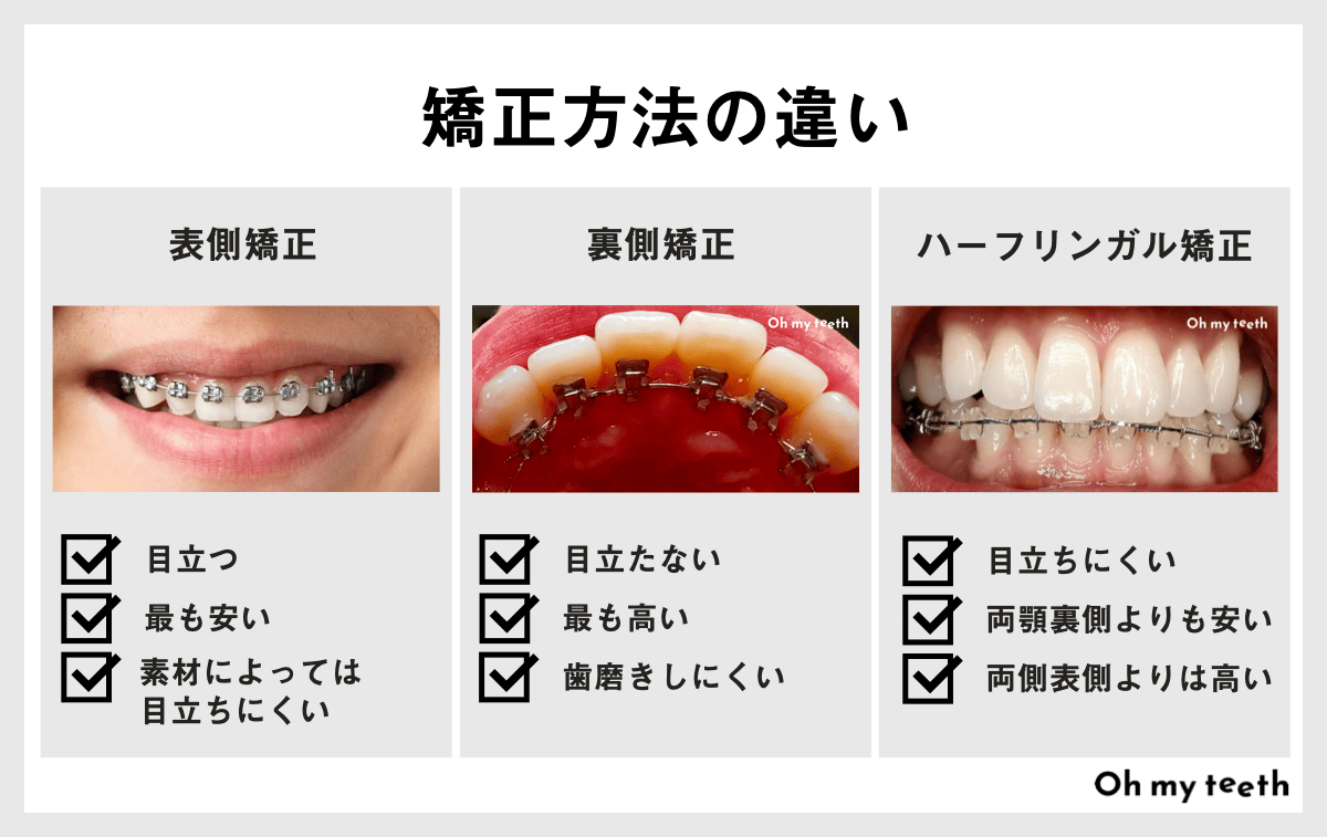 安いワイヤー矯正は大丈夫？低価格な理由や選ぶ際の注意点を解説