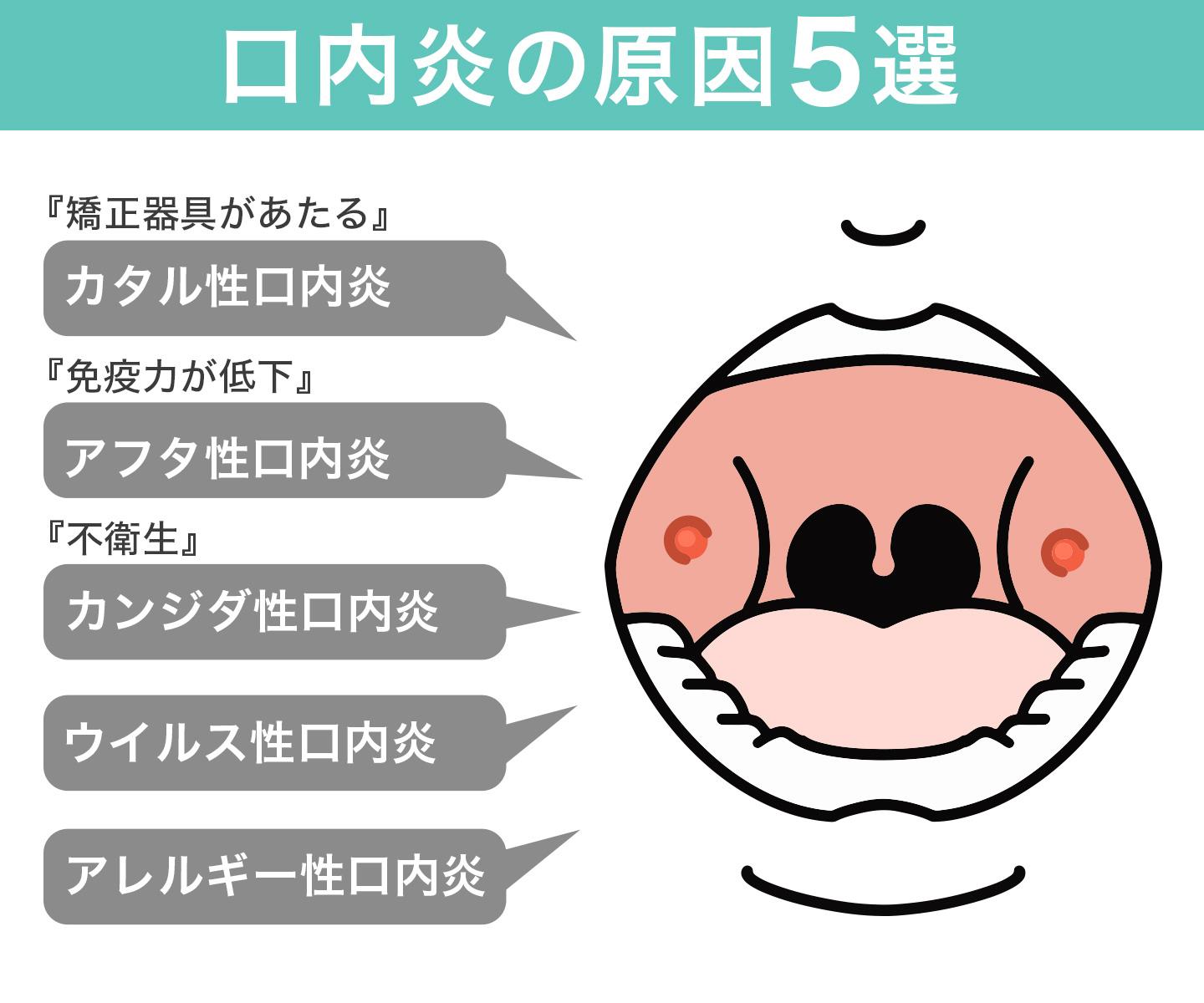 口内炎の5種類
