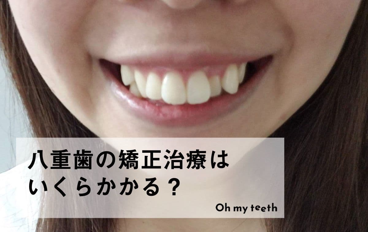 八重歯矯正の費用を種類別に比較！特徴や目安期間もあわせて紹介
