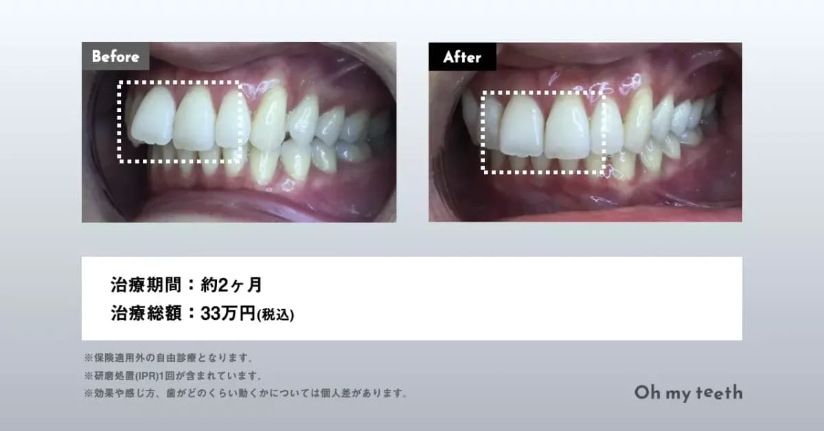 マウスピース矯正 Oh my teethの出っ歯の症例(部分矯正・非抜歯矯正)