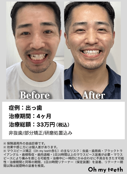 全顔BA・出っ歯