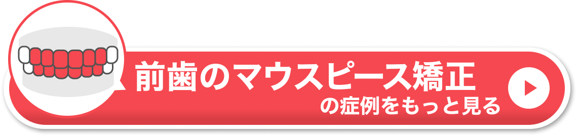 前歯のマウスピース矯正の症例をもっと見る