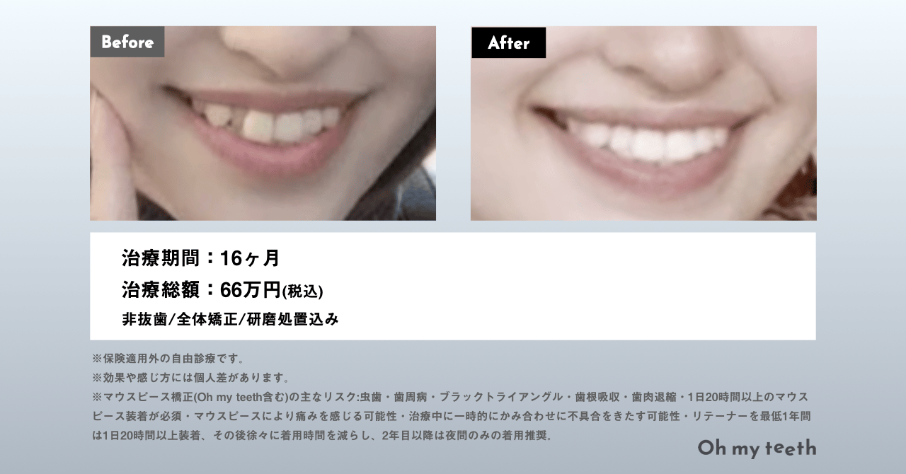 マウスピース矯正 Oh my teethの症例(叢生・八重歯・女性・顔貌変化)