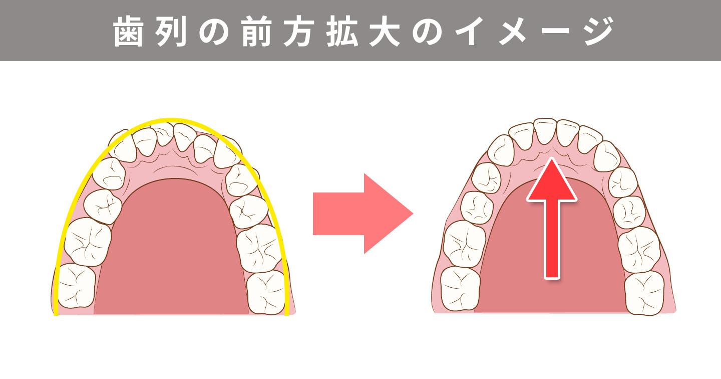 歯列の前方拡大のイメージ