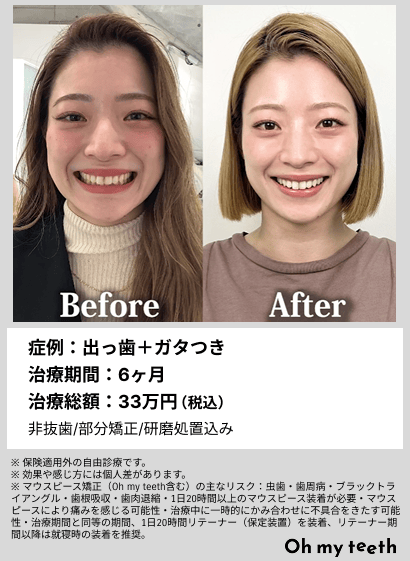 全顔BA・出っ歯+ガタつき
