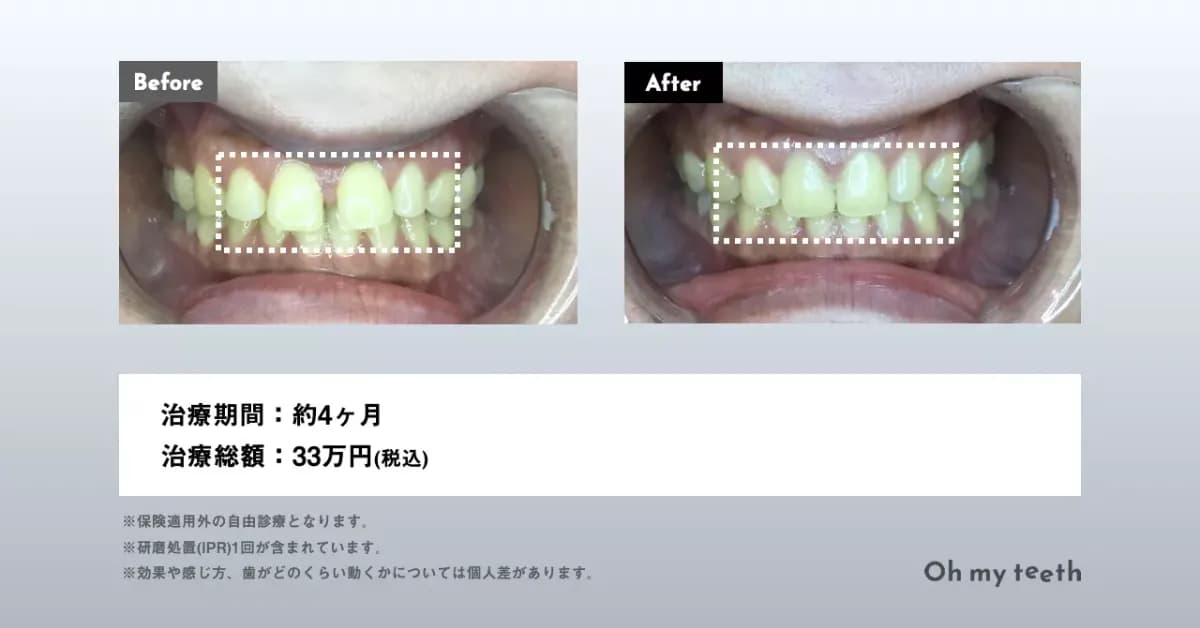 マウスピース矯正 Oh my teethのすきっ歯(空隙歯列)の症例(部分矯正・非抜歯矯正)