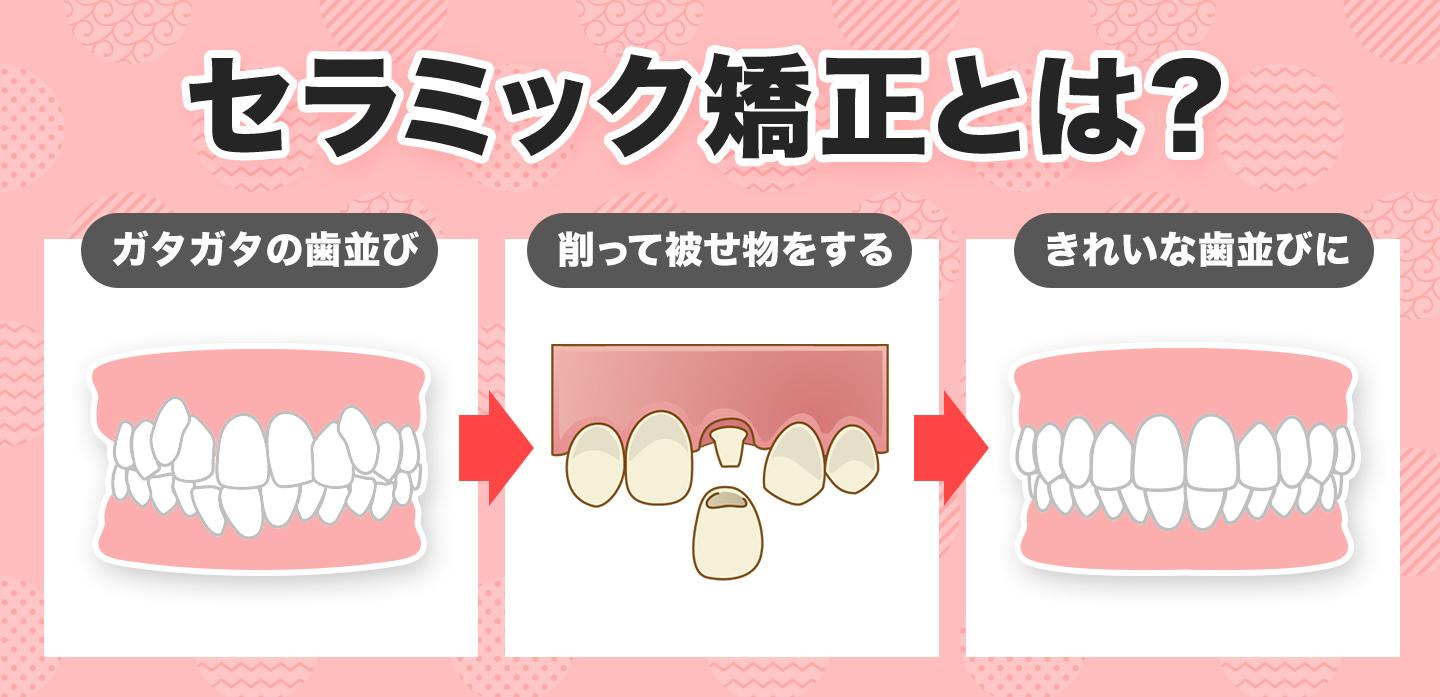 芸能人に人気の「セラミック治療」とは？