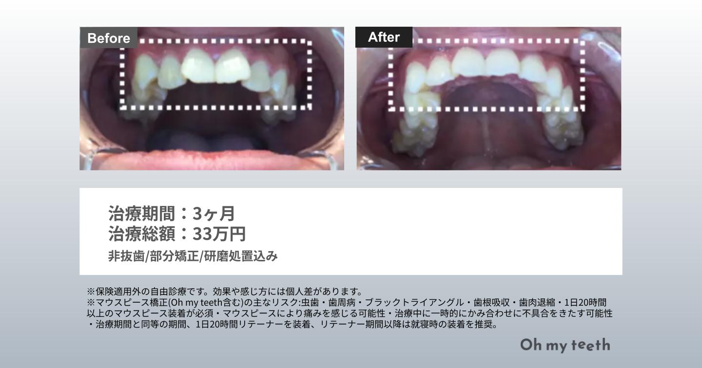 捻転歯 症例写真（ねじれ３ヶ月）