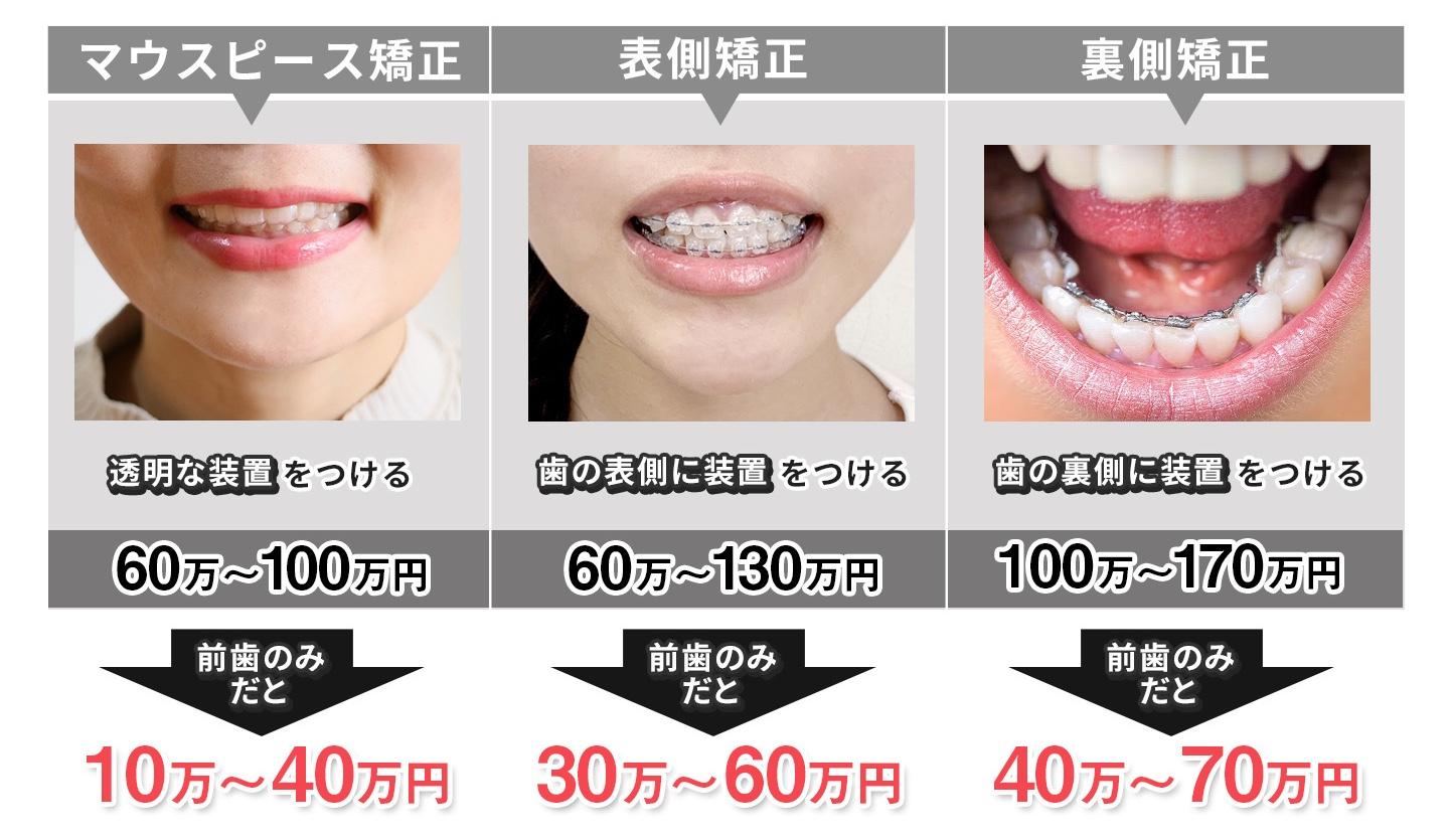 前歯だけの矯正の種類と費用目安