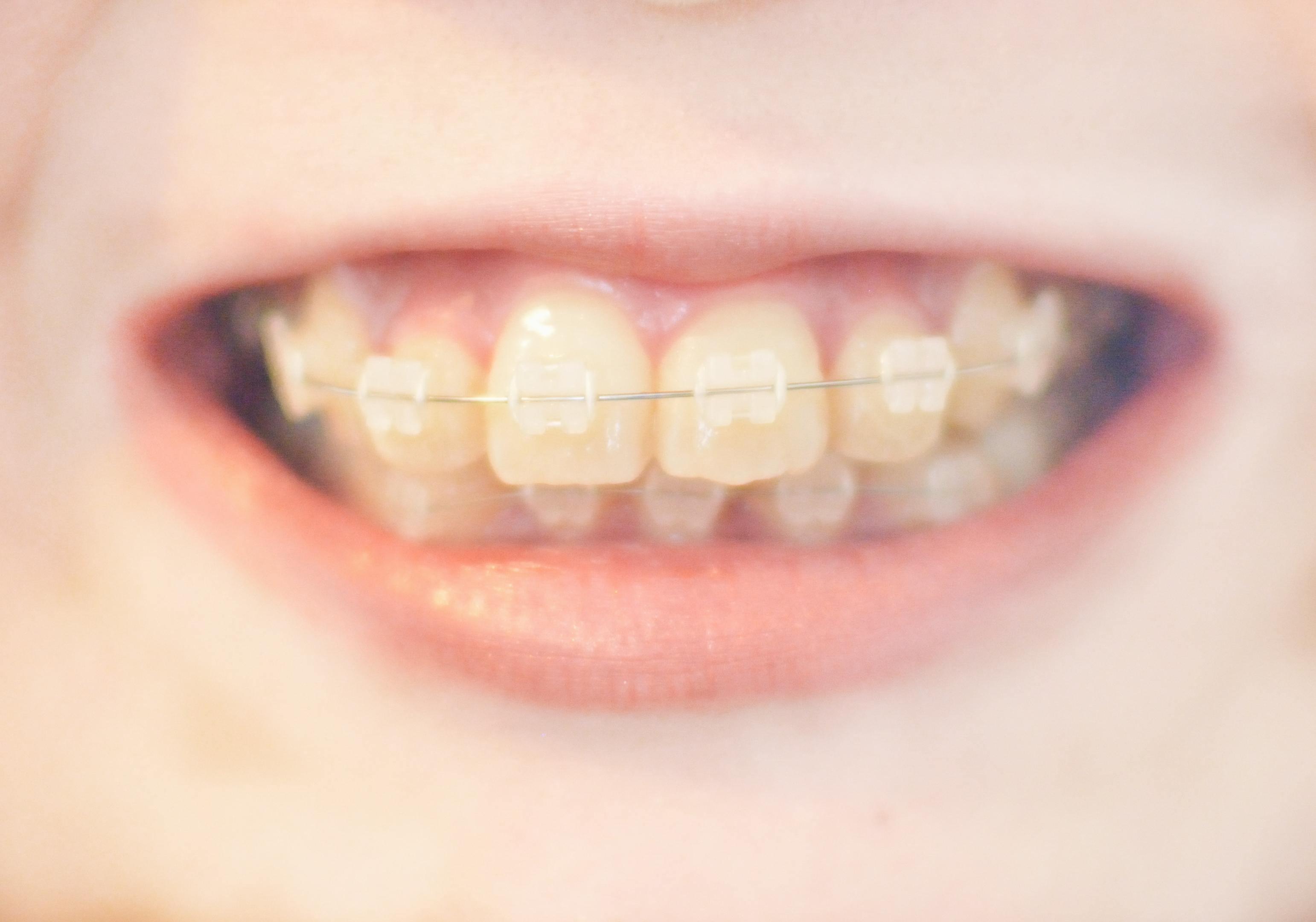 八重歯は部分矯正で治せる？かかる費用や期間についても解説