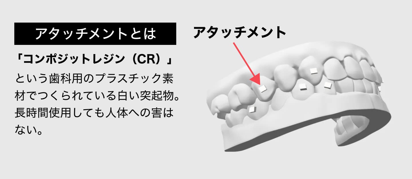 インビザラインのアタッチメントとは？絶対必要？気になる疑問を解説