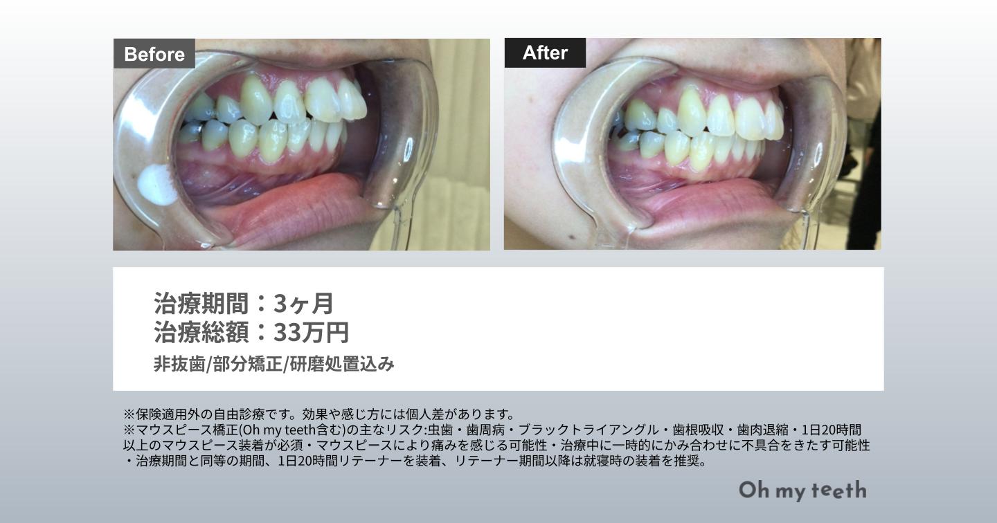 部分矯正 出っ歯 症例画像①