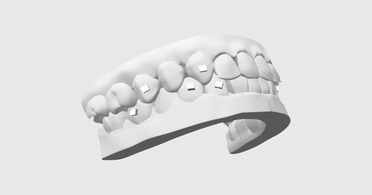 アタッチメントがついた歯型のイメージ