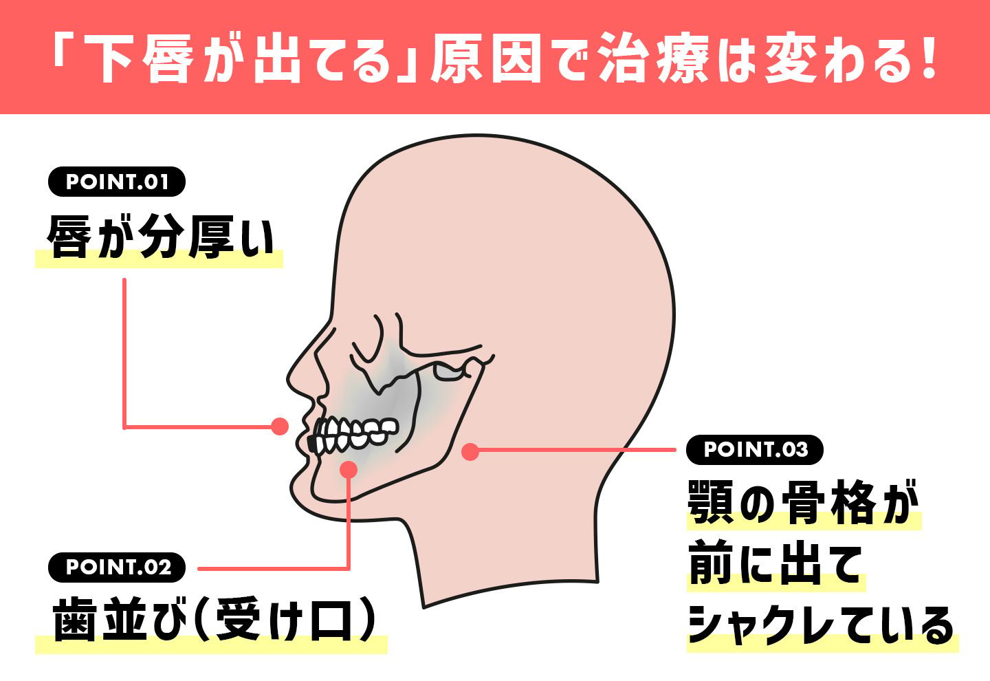 下唇が出てる原因で治療が変わる