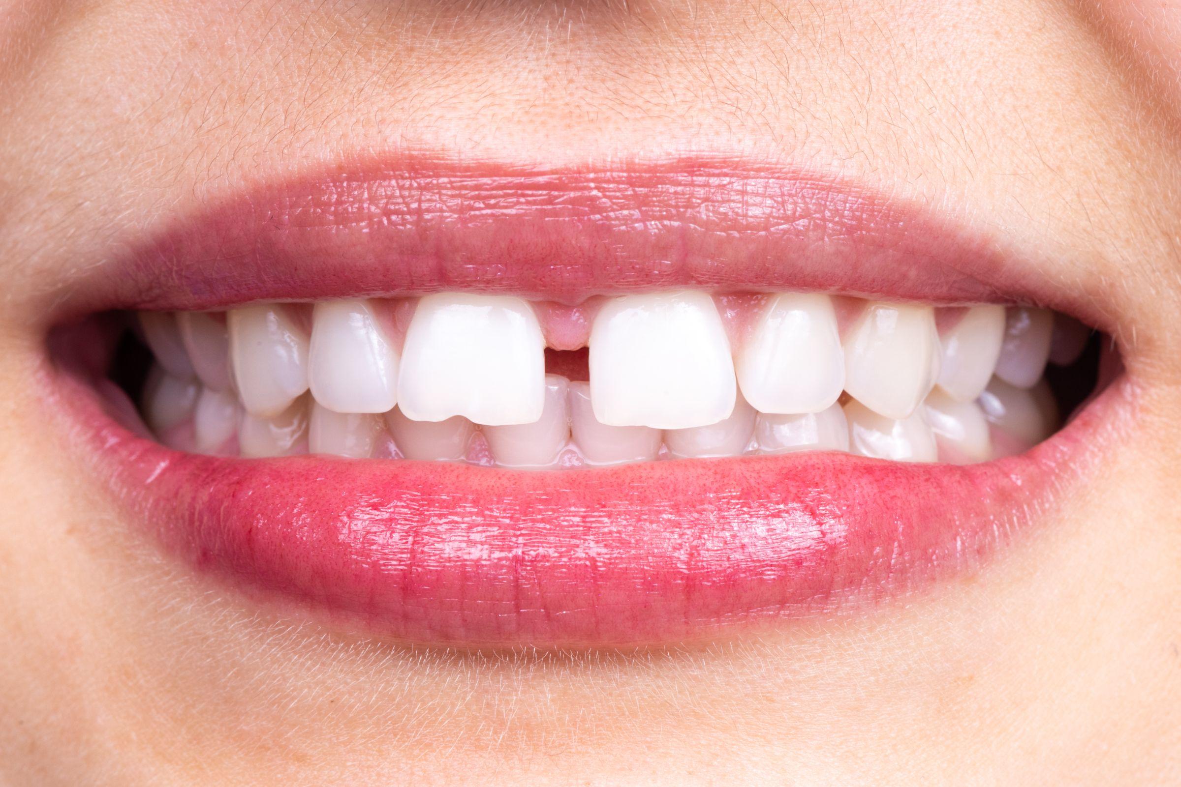 すきっ歯の原因と治療法を解説 自然に治る？自力で治せる？
