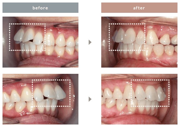 エミニナル矯正の出っ歯の症例