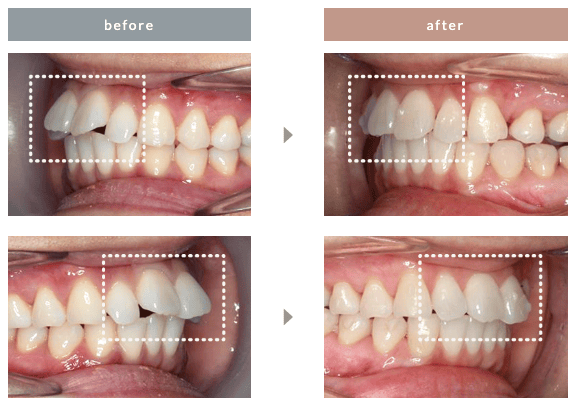 エミニナル矯正の出っ歯の症例